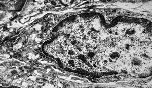 F,41y. | synovial metaplasia - capsule of implantate F,41y. | synovial metaplasia - capsule of implantate